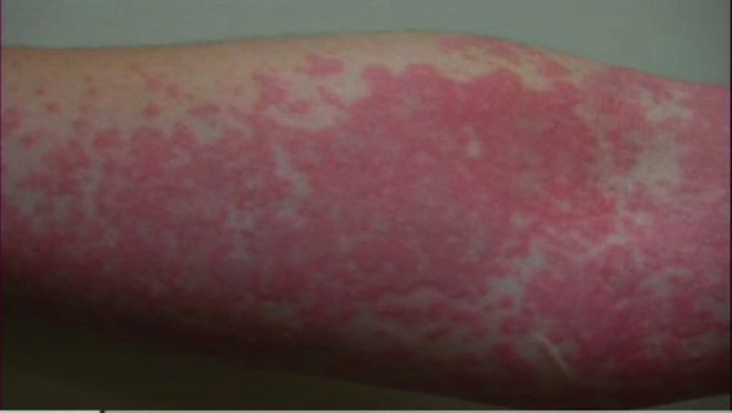 Résultat de recherche d'images pour "allergie cutanée"