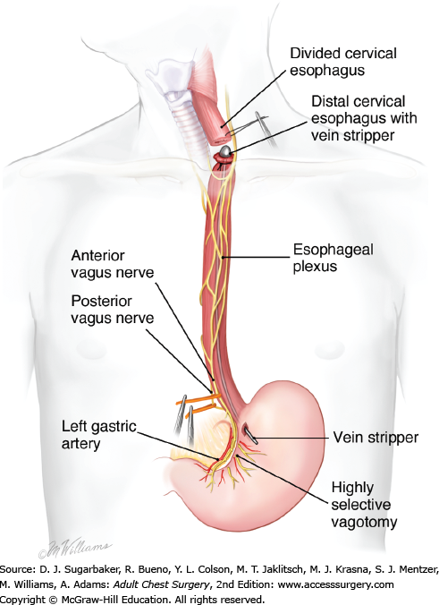 RÃ©sultat de recherche d'images pour "esophagus resection stripping"